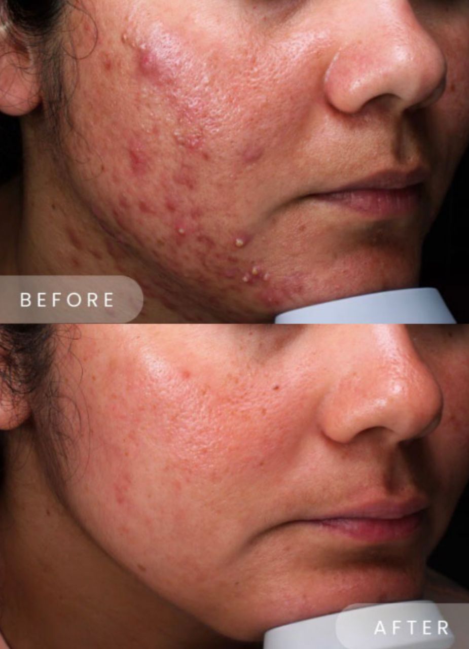 ICE ROLLER + SERUM  ANTIACNE  BIOAQUA