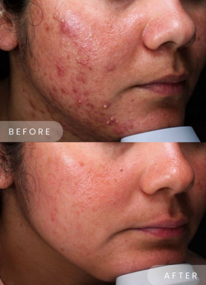 ICE ROLLER + SERUM  ANTIACNE  BIOAQUA